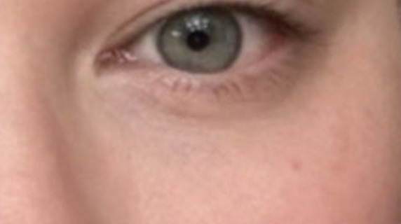 January 2026: Scar is minimally perceptible, with substantial improvement in tone, contour and integration with surrounding tissue.