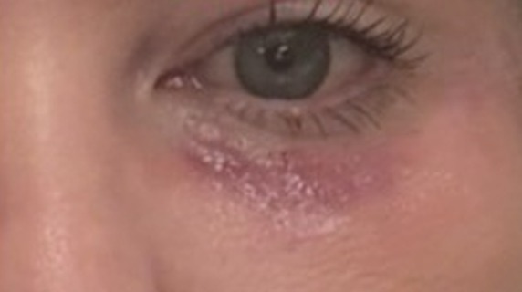 August 2025: Baseline. Prominent discoloration, surface irregularity and visible scar borders at the start of twice-daily use.