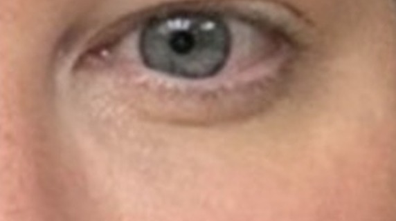December 2025: Continued normalization of pigmentation and texture, with softer scar margins.